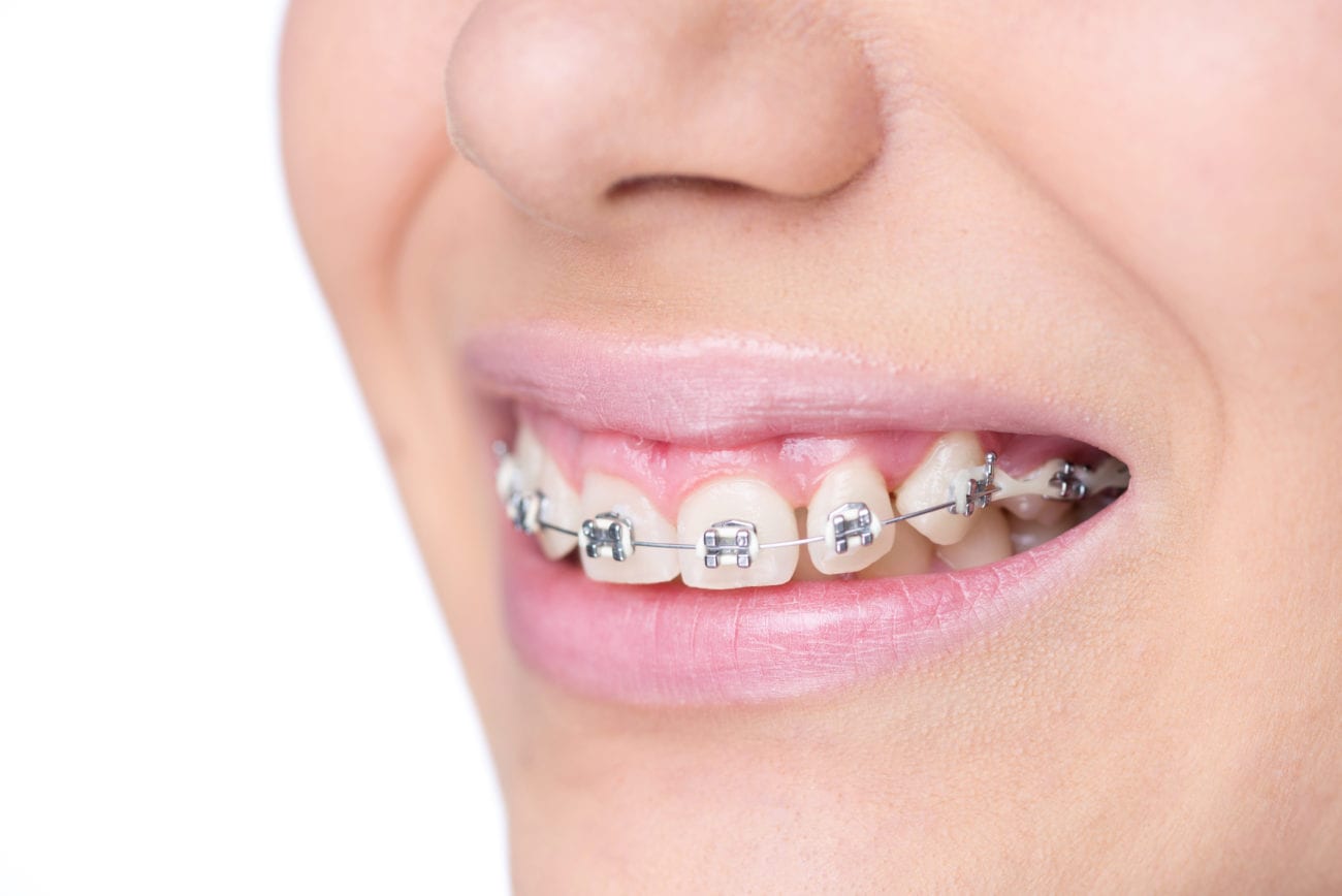 A Guide To Maintaining Braces Silver Spring MD Orthodontist