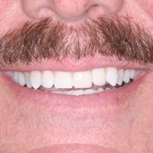 Silver Spring MD dental implants specialist