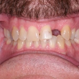 before dental implant for missing teeth by Silver Spring dentist