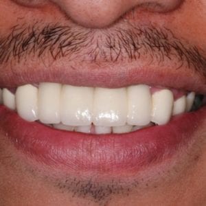 dental bridge procedure for missing teeth with Dr David Rever