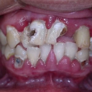 dental bridge procedure for missing teeth