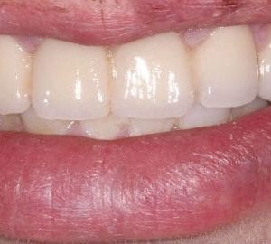 smile makeover in Silver Spring MD