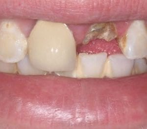 smile makeover in Silver Spring MD