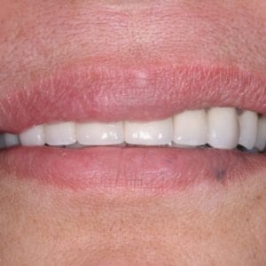 after dental crowns at Advanced Total Dental Care