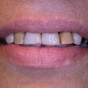 before dental crowns at Advanced Total Dental Care