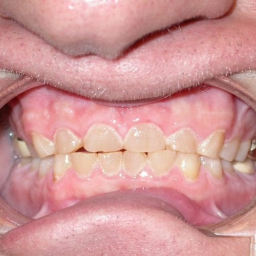 Before Cosmetic Dentistry at Advanced Total Dental Care