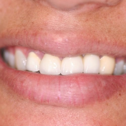 Before Cosmetic Dentistry at Advanced Total Dental Care