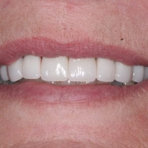 Dental crowns for damaged teeth in Silver Spring MD