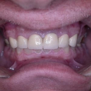 Teeth grinding treatments in Silver Spring MD