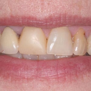Dental crowns for damaged teeth in Silver Spring MD