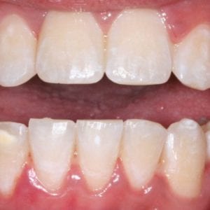 orthodontics for impacted teeth in Silver Spring MD