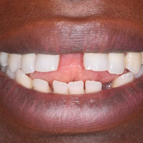 Before Cosmetic Dentistry at Advanced Total Dental Care