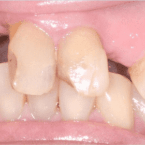 Crowns replacement in Silver Spring MD with Dr. David Rever