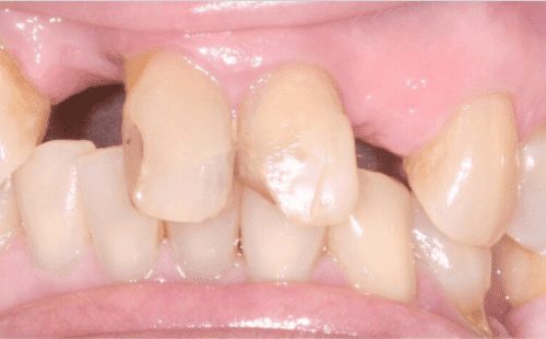 Before Cosmetic Dentistry at Advanced Total Dental Care