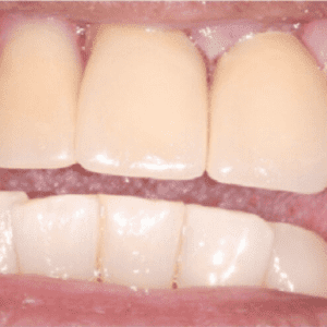 Crowns replacement in Silver Spring MD with Dr. David Rever