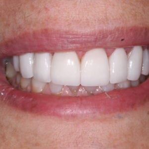 dental veneers for a gummy smile in Silver Spring MD