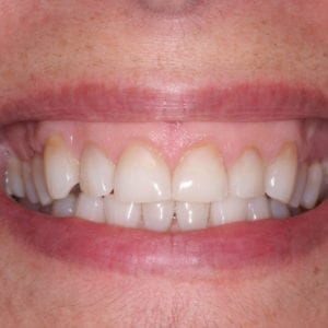 dental veneers for a gummy smile in Silver Spring MD