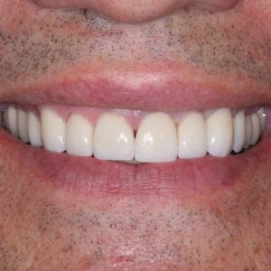 after dental veneers with Dr Rever at Advanced Total Dental Care
