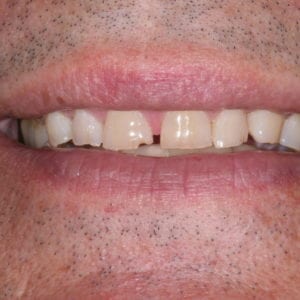 before dental veneers with Dr Rever at Advanced Total Dental Care