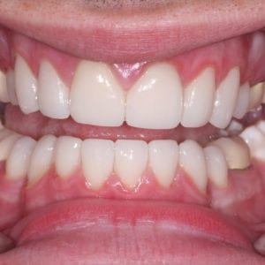 Silver Spring MD dentist dental veneers results