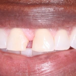 Silver Spring MD cosmetic dentist applies dental veneers