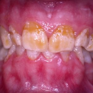 porcelain veneers in Silver Spring MD with Dr. Rever