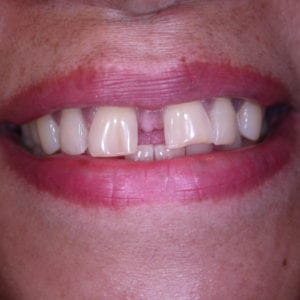 porcelain veneers for gaps in teeth