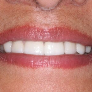 Silver Spring Porcelain veneers results by Dr David Rever