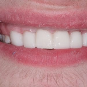 Porcelain veneers procedure in Silver Spring MD