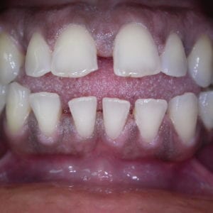 Porcelain veneers for wide tooth gaps