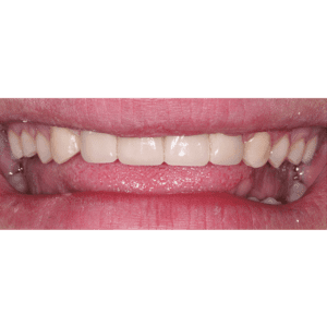 Replace missing teeth with dental implants in Silver Spring MD