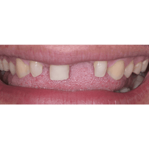 Replace missing teeth with dental implants in Silver Spring MD