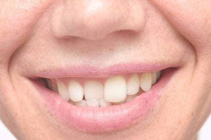 Silver Spring, MD misaligned teeth