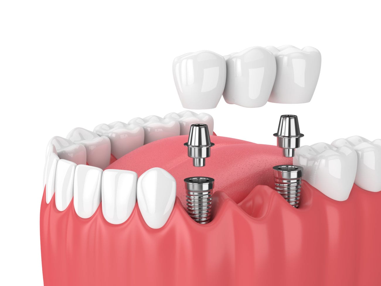 Dental Implant Process in Silver Spring, MD