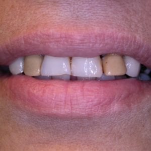 Before Cosmetic Dentistry at Advanced Total Dental Care