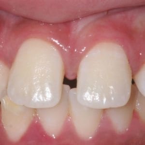 Before Cosmetic Dentistry at Advanced Total Dental Care