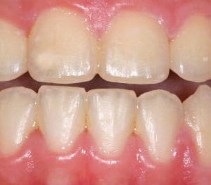 After Cosmetic Dentistry at Advanced Total Dental Care