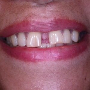 Before Cosmetic Dentistry at Advanced Total Dental Care