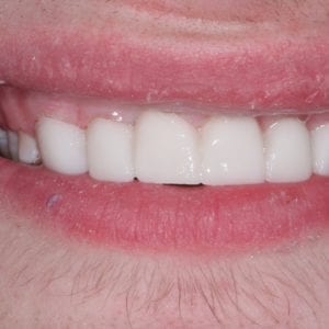 After Cosmetic Dentistry at Advanced Total Dental Care