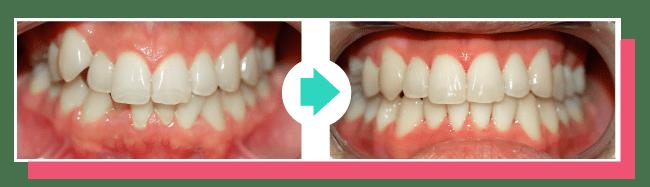 Before and after ClearCorrect aligner treatment in Silver Spring Maryland