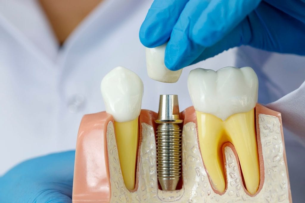 Single Dental Implant in silver spring, maryland