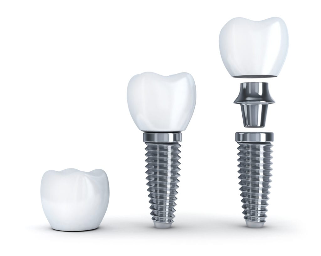 Pros and Cons of Dental Implants in Silver Spring, MD