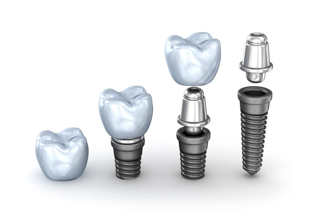 cost of dental implants in silver spring, maryland