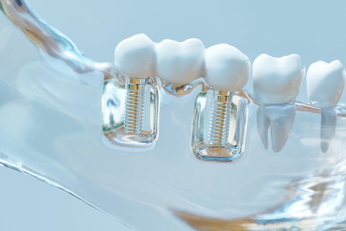 multiple dental implants in silver spring, maryland