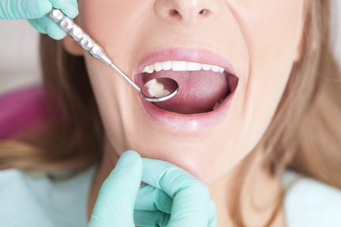 dental fillings in silver spring, maryland