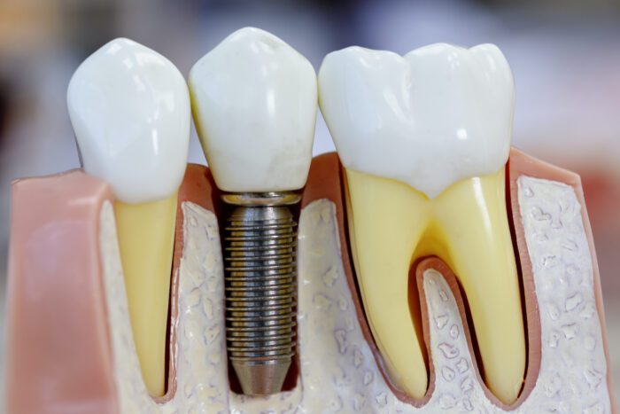 dental implant process in silver spring, md