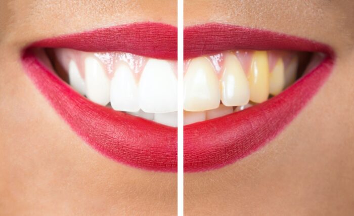 teeth whitening in silver spring, maryland