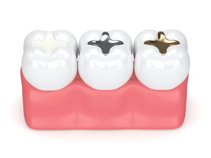 Are Dental Fillings Permanent