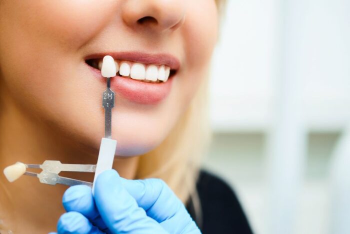 Are Porcelain Veneers Right for Me