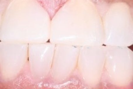 before and after pictures